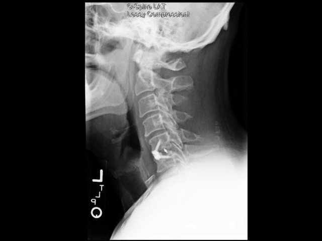 Exhibit 6 (C-spine)